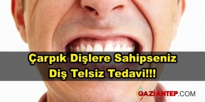 Çarpık Dişler İçin Çözüm