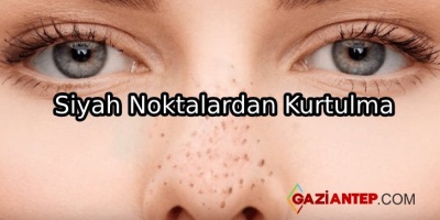 Sivilce Ve Siyah Noktalardan Kurtulma Önerileri