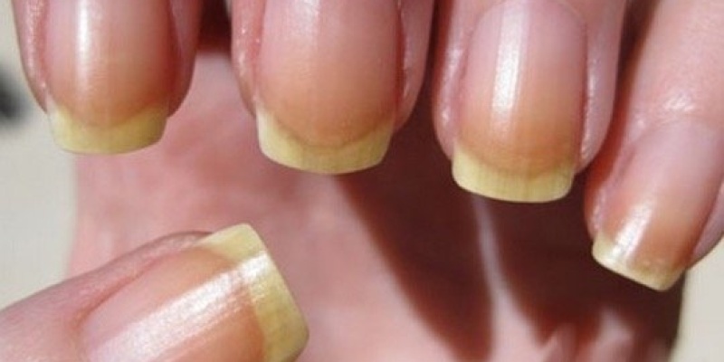 Tırnak Sararması Neden Olur? Tırnak Sararması Nasıl Engellenir?