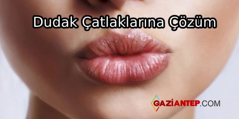 Dudak Çatlaklarına Çözüm Önerisi