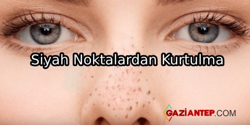 Sivilce Ve Siyah Noktalardan Kurtulma Önerileri